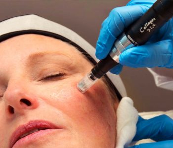 MiraBelle_Microneedling-01-1